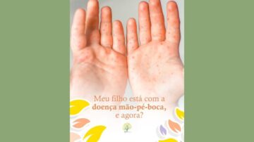doença mão, pé e boca